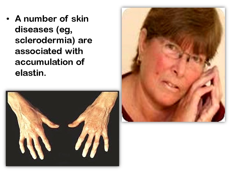 A number of skin diseases (eg, sclerodermia) are associated with accumulation of elastin.